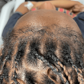 traction alopecia before prp