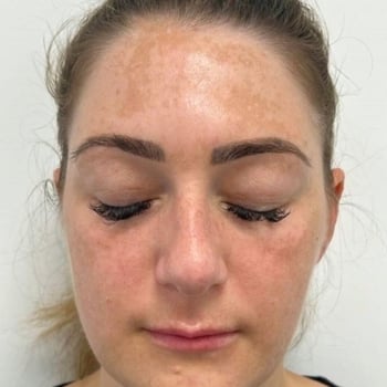 cosmelan melasma before and after 1