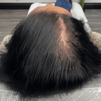 menopausal hair loss after prp