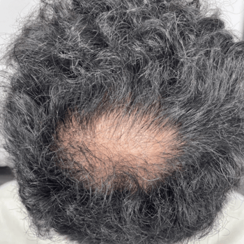 alopecia before prp