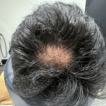 alopecia after prp