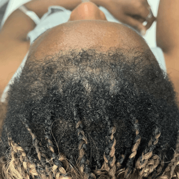 traction alopecia after prp