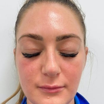melasma before and after 2