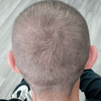 hair density before prp