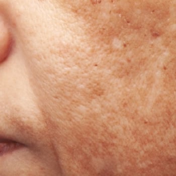 pigmentation treatment before and after 1