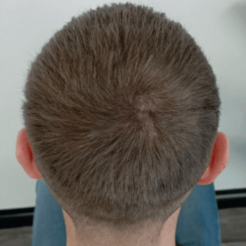 hair density after prp