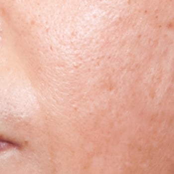 pigmentation treatment before and after 2