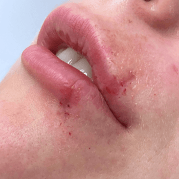 scar before prp