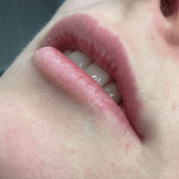 scar after prp