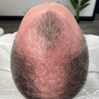 before prp and hair implant
