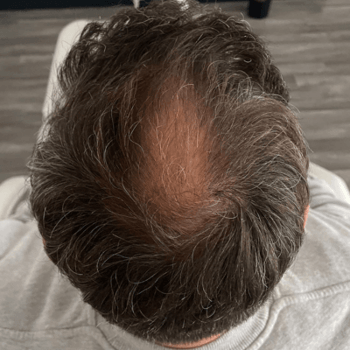 after prp and hair implant