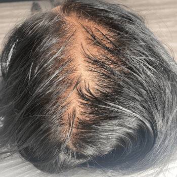 menopausal hair loss before prp