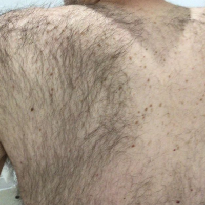 Before and After laser hair removal 2