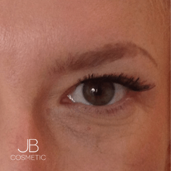 after tear trough filler