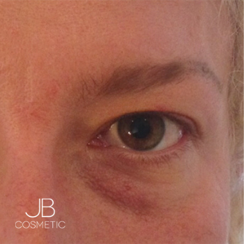 before tear trough filler