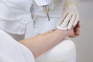 Preparing for Laser Tattoo Removal