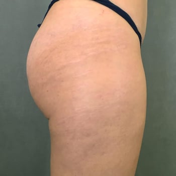 after secret rf body 1
