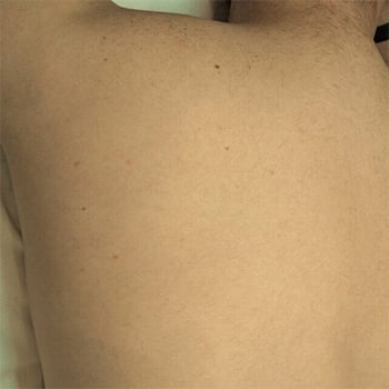 after-laser-hair-removal