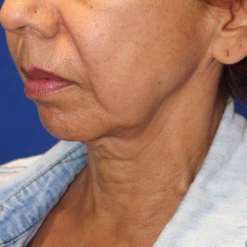 before secret rf face 1 Morpheus8