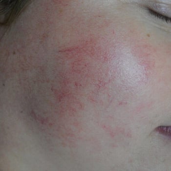 clear-vein-2-before