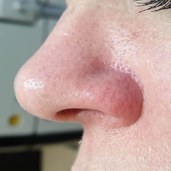 clear-vein-treatment-after
