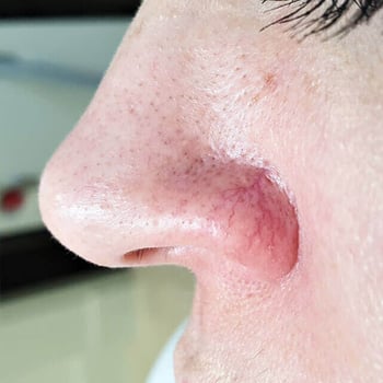 clear-vein-treatment-before