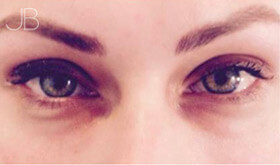eye-bag-removal-1-after