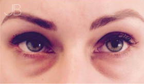 eye-bag-removal-1-before