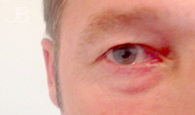 eye-bag-removal-3-after
