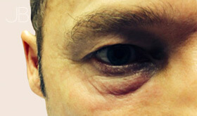 eye-bag-removal-3-before