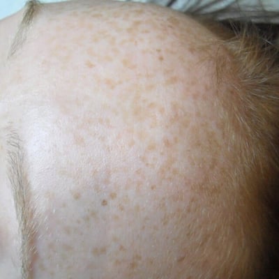 hyperpigmentation-before