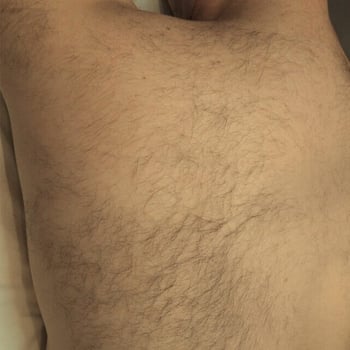 laser-hair-before
