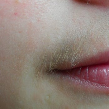 Laser Hair Removal In Bristol The Hampton Clinic I highly recommend laser treatments in planet beauty. laser hair removal in bristol the