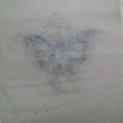 tattoo-removal-after