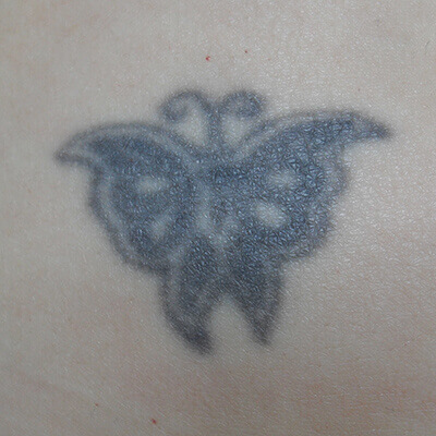 tattoo-removal-before