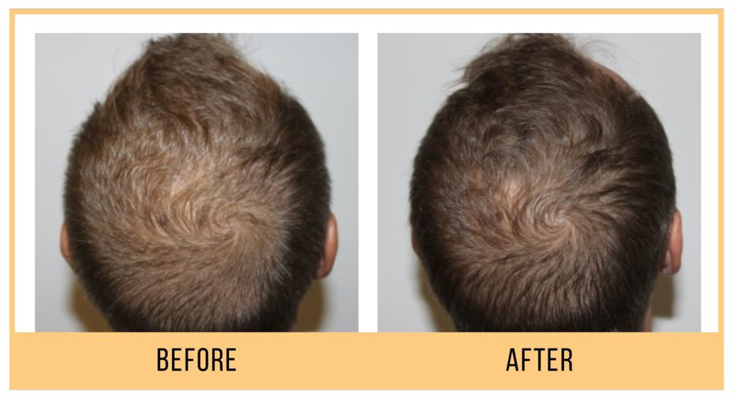 Keravive-BeforeAndAfter1-1024x559