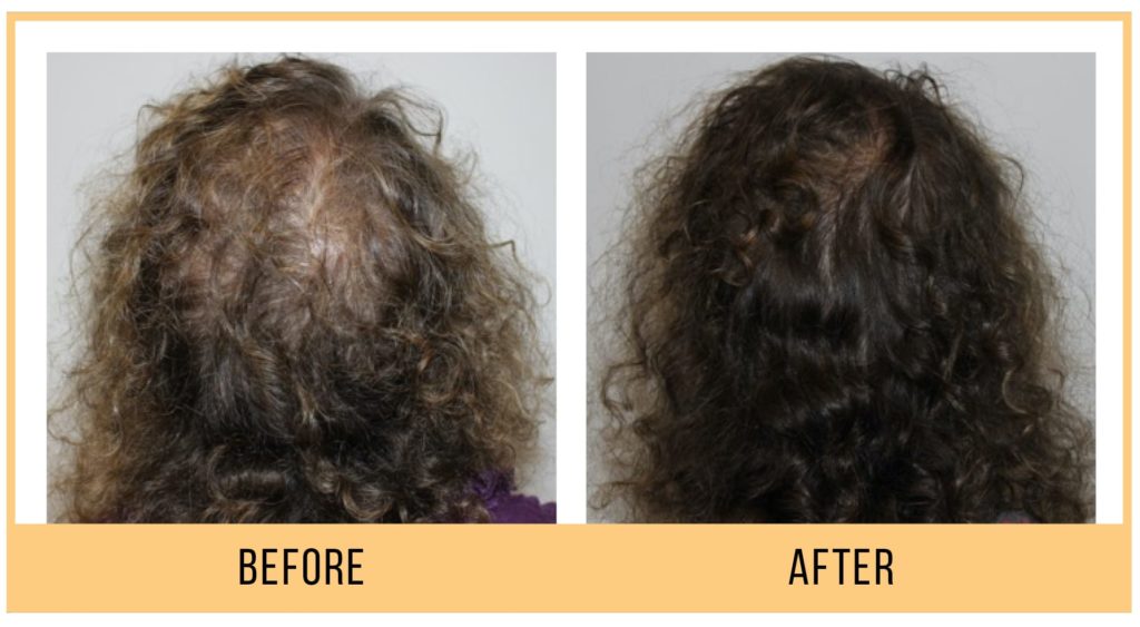 Keravive-BeforeAndAfter2-1024x563