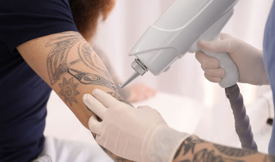 After laser tattoo removal in summer is it safe to go out