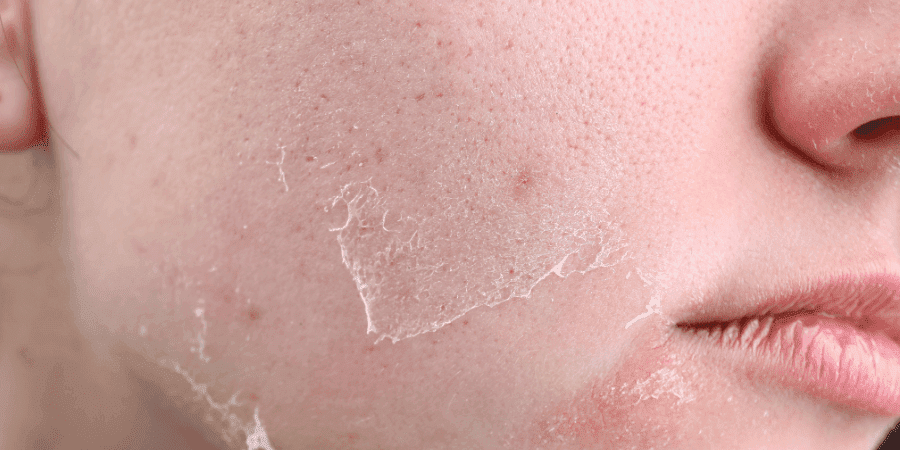 skin peels in bristol