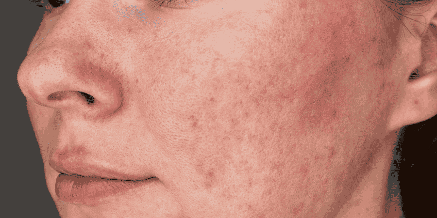 rosacea treatment in bristol
