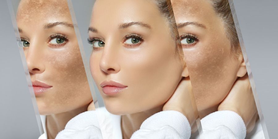 cosmelan treatment in bristol