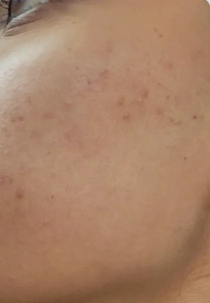 The same cheek after laser skin resurfacing at The Hampton Clinic, with the breakout settled