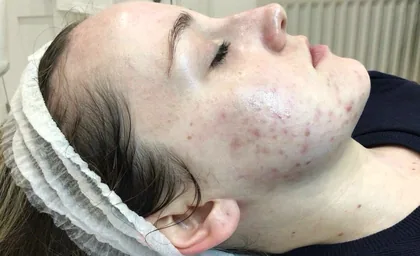 Active acne across the cheek and jaw of a female patient before laser skin resurfacing at The Hampton Clinic