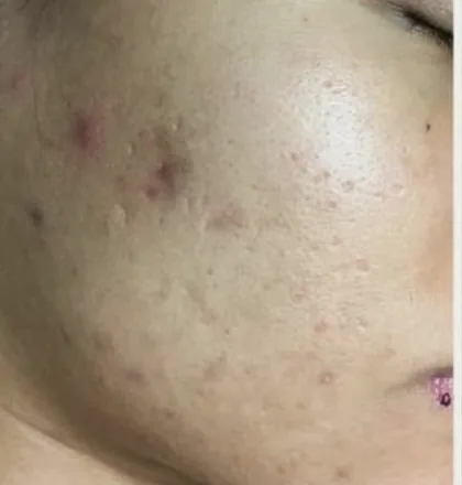 Active acne and marks on a female patient's cheek before laser skin resurfacing at The Hampton Clinic