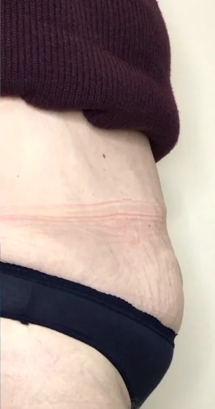 The same abdomen in profile after a body contouring programme, with an improved contour