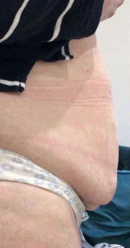 Abdomen photographed in profile before a body contouring programme at The Hampton Clinic, Bristol