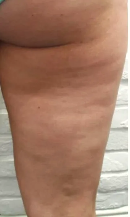 The appearance of cellulite on the upper thigh before a body contouring programme at The Hampton Clinic