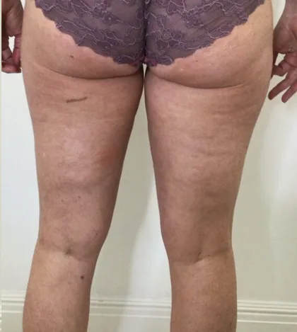 The same rear thigh after a body contouring programme, smoother in texture and contour
