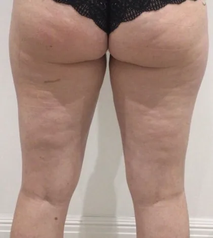 Rear thigh of a female patient before a body contouring programme at The Hampton Clinic, Bristol