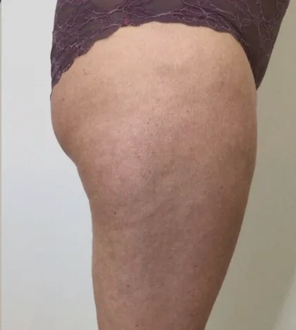 The same patient after a body contouring programme, with a smoother thigh and hip contour